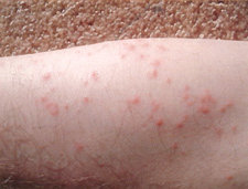 an arm isolated showing bed bug bites  